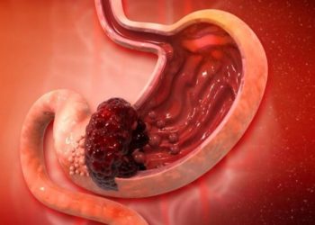 Ayo Cari Tahu, Apa Itu Kanker Lambung